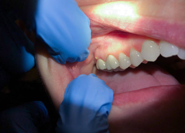 Best Emergency Dental Extractions in Gorman, NC